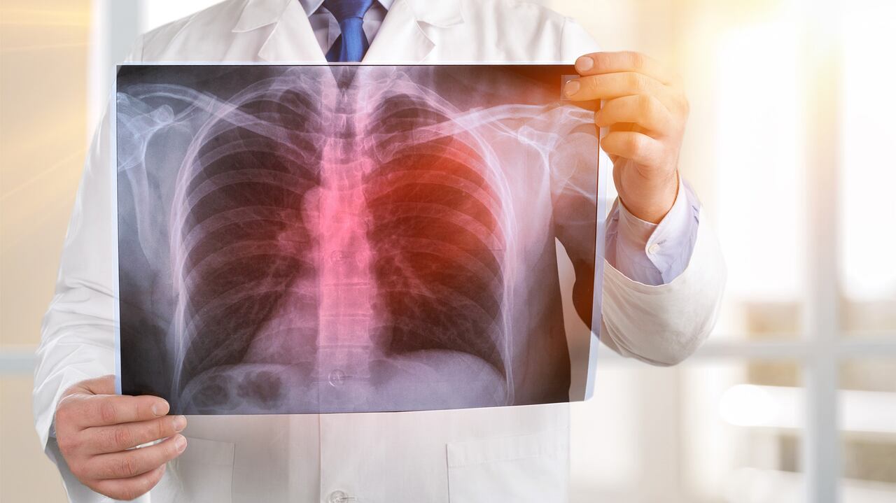 Detectado a tiempo, la tuberculosis se cura. Foto: Shutterstock