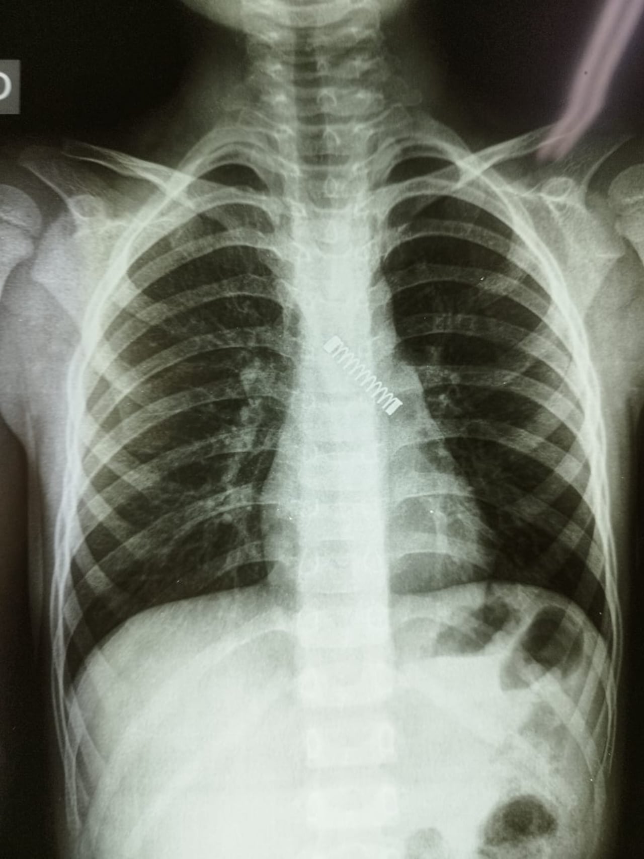 Niño tragó un resorte y pasó 3 meses con el objeto en los pulmones. Foto: Gentileza